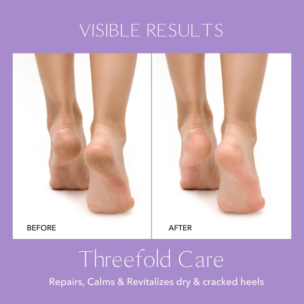 feet skin result before and after